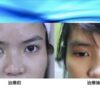 半永久雙眼皮