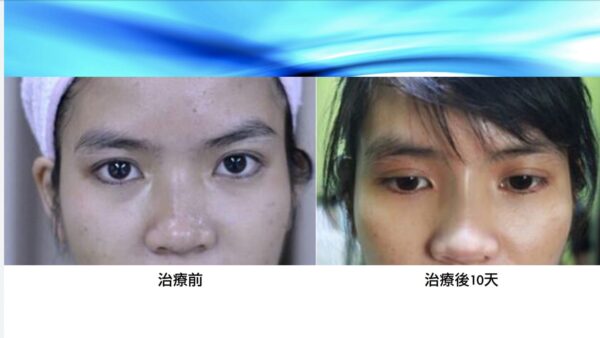 半永久雙眼皮