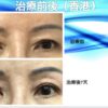 半永久雙眼皮