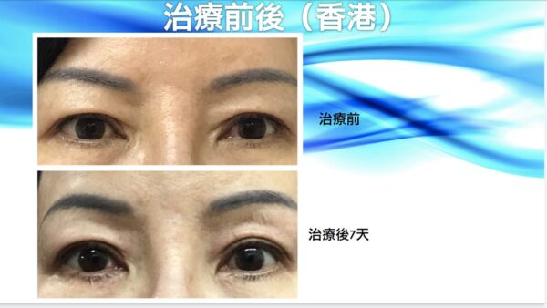 半永久雙眼皮
