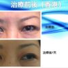 半永久雙眼皮