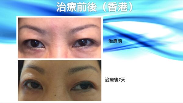 半永久雙眼皮