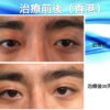半永久雙眼皮