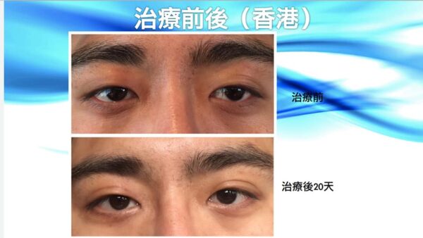 半永久雙眼皮